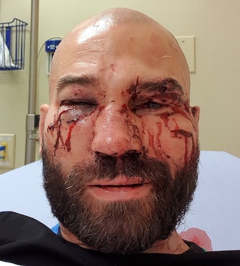 Artem Lobov mostró una imagen de su rostro después de su triunfo en el BKFC (@MMA_Fusion)