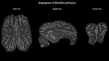 Angiograma de la perfusión BrainEx.