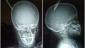 El cuchillo quedó enterrado en