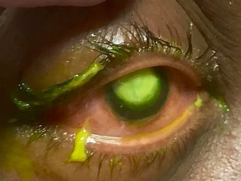 Las pseudomonas (bacterias) pueden causar