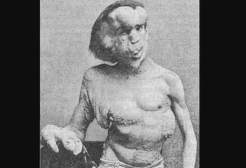 Joseph Merrick llevó una vida difícil debido a sus deformidades físicas (Foto: British Medical Journal)