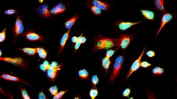 Células de glioma, el tumor