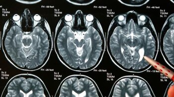 Evolución de un glioma en
