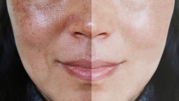 Las manchas de quemaduras causadas