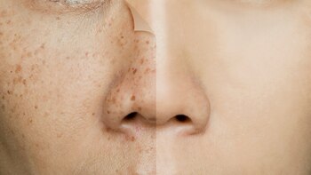 Diferencias entre las manchas de