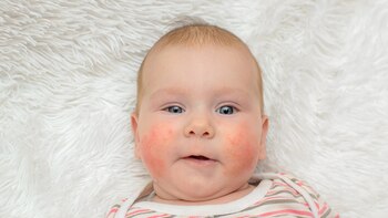 La APLV puede también afectar la piel, presentándose con eczemas, urticarias y/o edemas (Shutterstock)