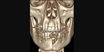 La lesión de Austin le ocasionó fractura de mandíbula y perder varios dientes Foto: New England Medical Journal