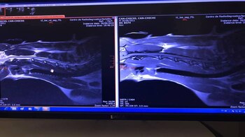 Una lesión en el tendón