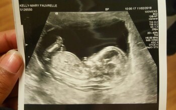 La imagen del ultrasonido (Foto: