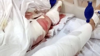 Así quedaron las piernas de la víctima luego del ataque de tres ovejeros en una playa de Mar del Plata