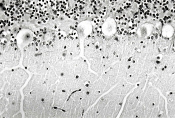 Esta patología afecta el sistema