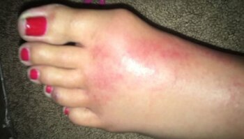 Guastucci notó un hematoma interno