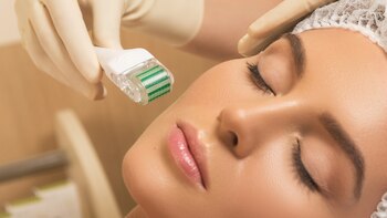 El microneedling es uno de