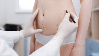 La liposucción de alta definición