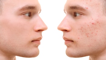 El acné es una enfermedad