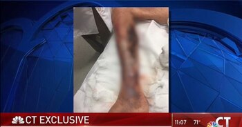 La fascitis necrosante causa la