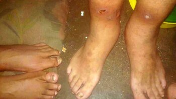 Lastimaduras en las piernas de