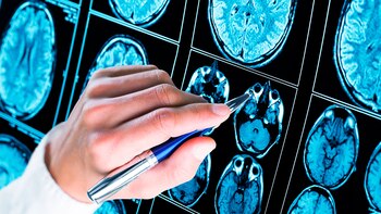 La migraña puede ser episódica