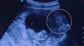 Esta imagen de la ecografía