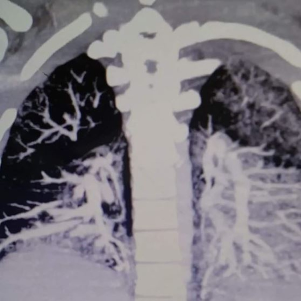 Parece un fumador de 60 aos": la brutal radiografa del dao que el vaping caus a los pulmones de un joven de 19 aos - Infobae Parece un fumador de 60 aos": la brutal radiografa del dao que el vaping caus a los pulmones de un joven de 19 aos - Infobae